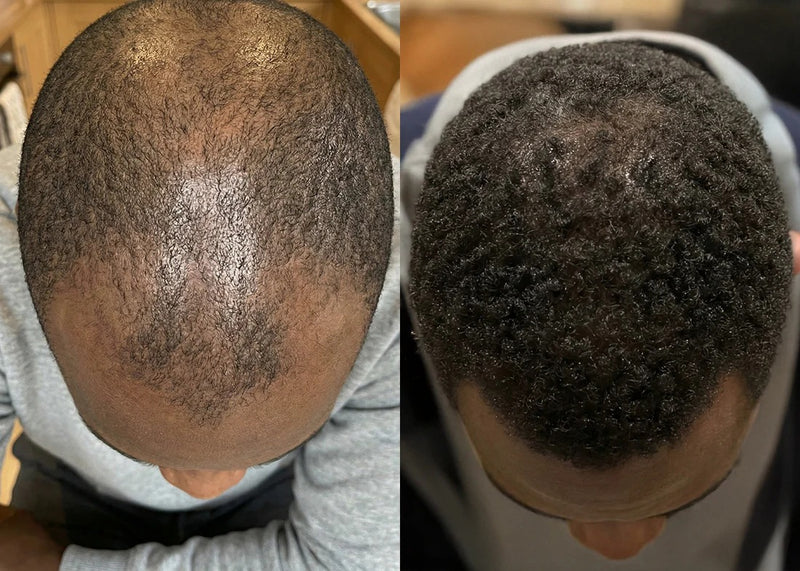 Résultat Avant/Après